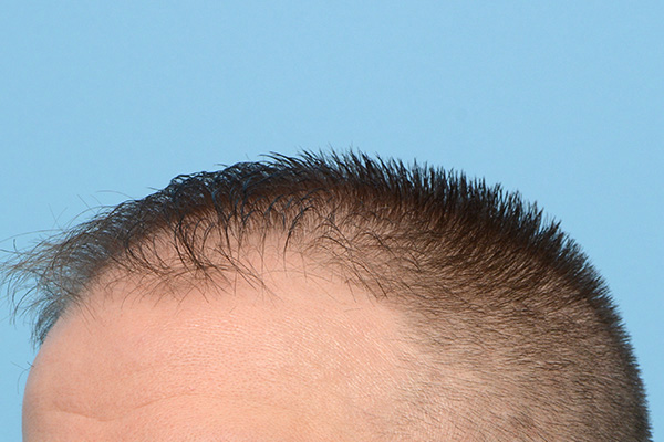 Fue Before and After | Dr. Jeffrey Wise