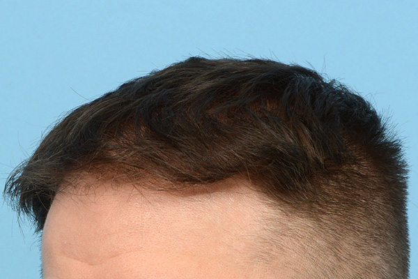 Fue Before and After | Dr. Jeffrey Wise