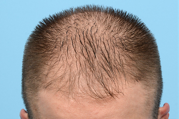 Fue Before and After | Dr. Jeffrey Wise