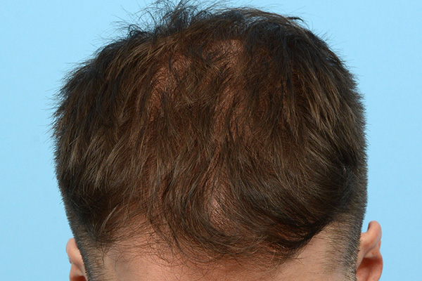 Fue Before and After | Dr. Jeffrey Wise