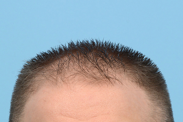 Fue Before and After | Dr. Jeffrey Wise