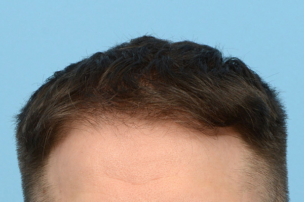 Fue Before and After | Dr. Jeffrey Wise