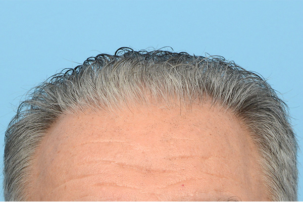 Fue Before and After | Dr. Jeffrey Wise