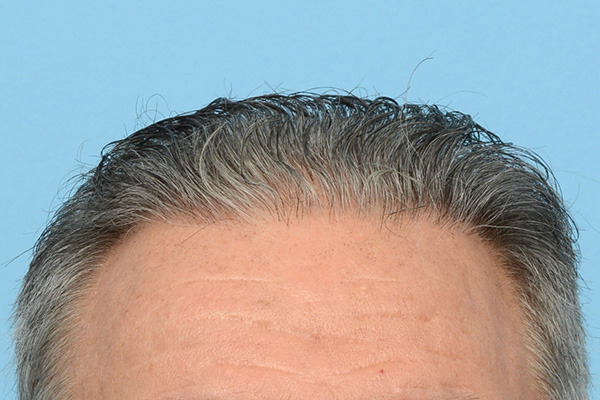 Fue Before and After | Dr. Jeffrey Wise