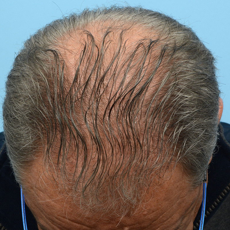 Fue Before and After | Dr. Jeffrey Wise