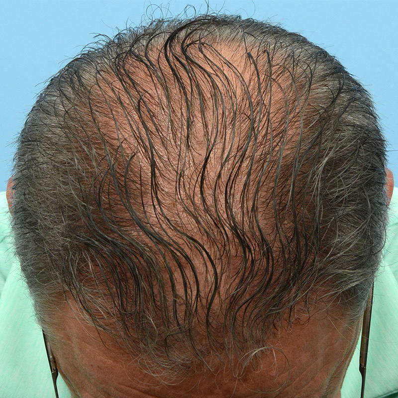 Fue Before and After | Dr. Jeffrey Wise