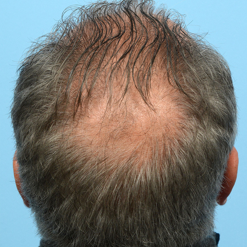 Fue Before and After | Dr. Jeffrey Wise