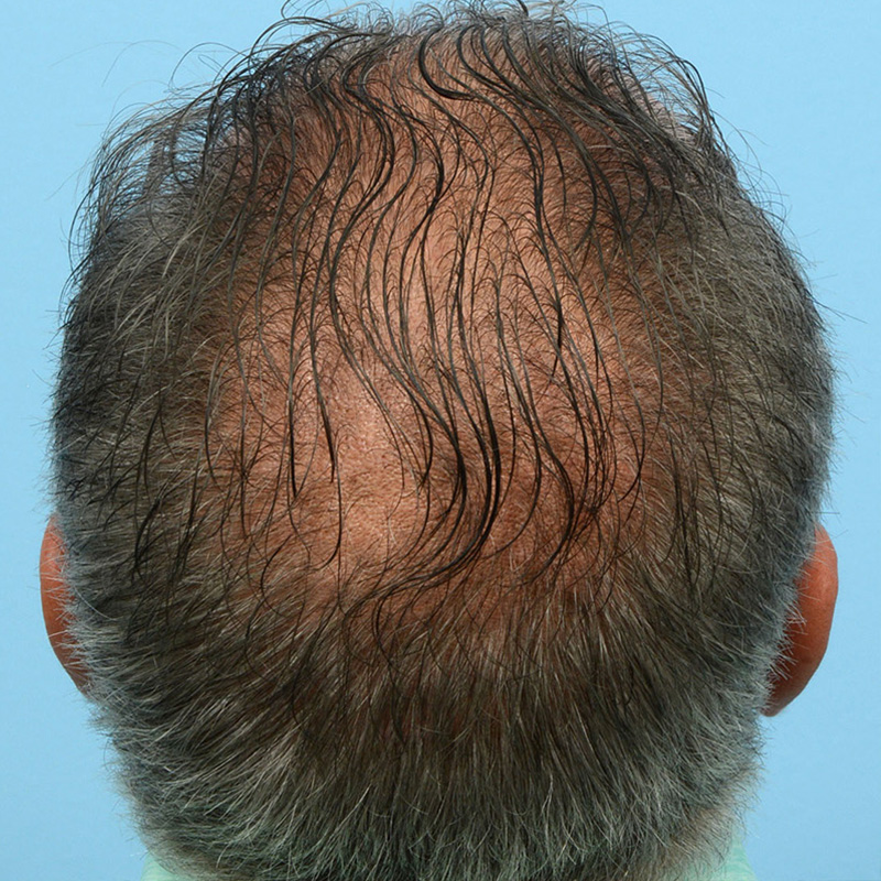 Fue Before and After | Dr. Jeffrey Wise