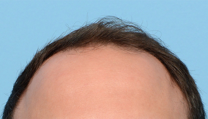 Fue Before and After | Dr. Jeffrey Wise