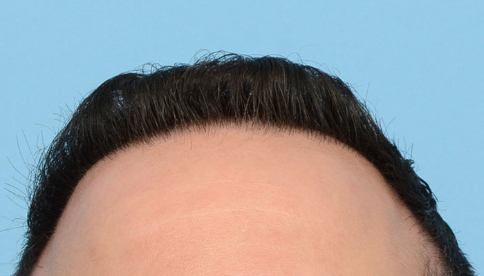 Fue Before and After | Dr. Jeffrey Wise