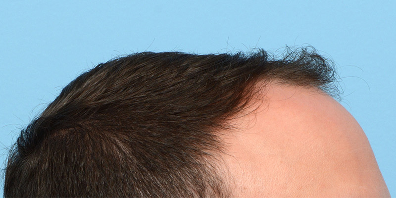 Fue Before and After | Dr. Jeffrey Wise