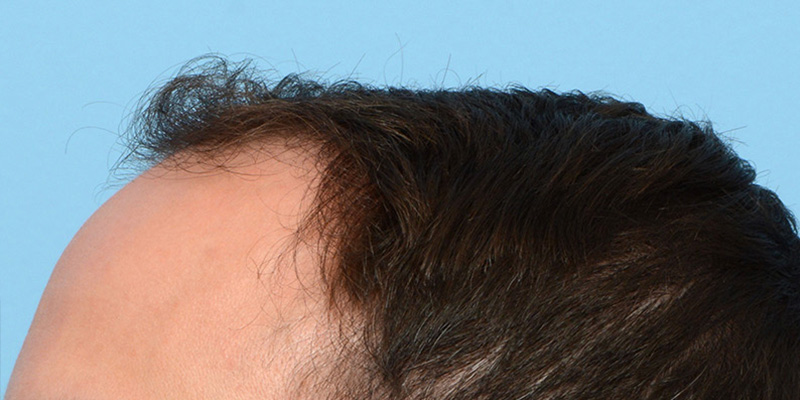 Fue Before and After | Dr. Jeffrey Wise