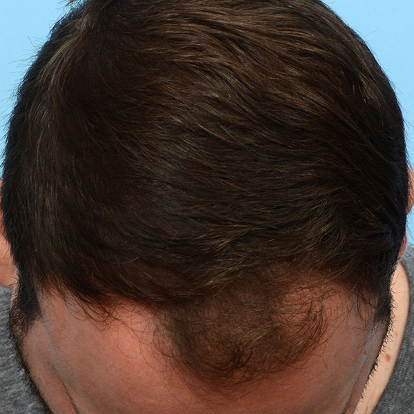 Fue Before and After | Dr. Jeffrey Wise