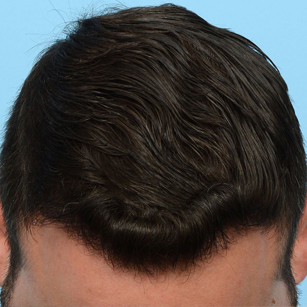 Fue Before and After | Dr. Jeffrey Wise