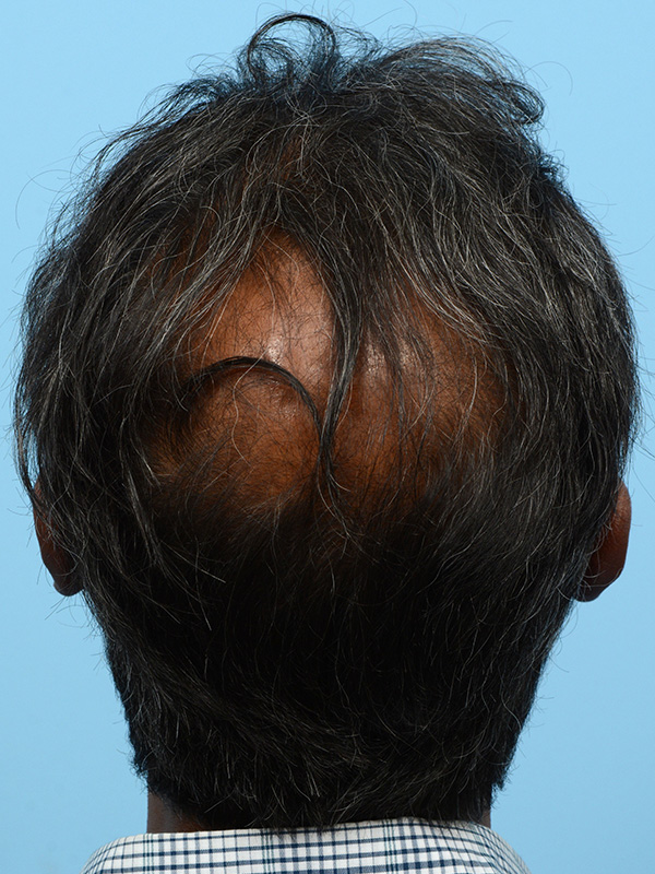 Fue Before and After | Dr. Jeffrey Wise