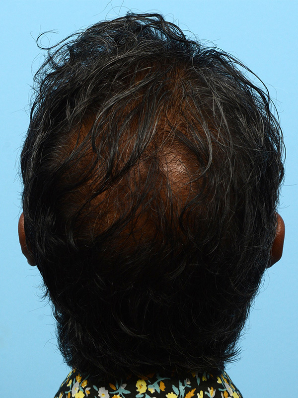 Fue Before and After | Dr. Jeffrey Wise