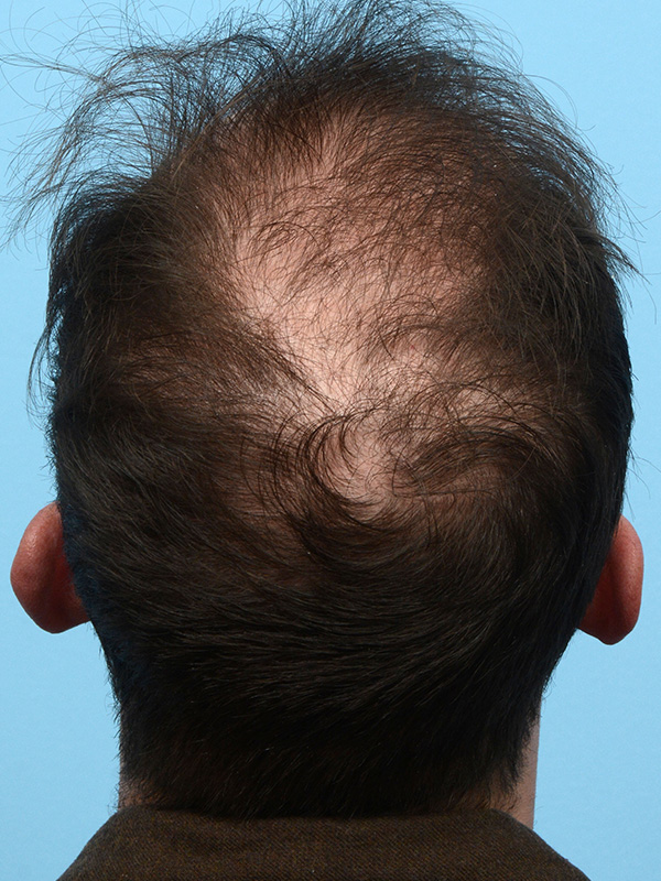 Fue Before and After | Dr. Jeffrey Wise