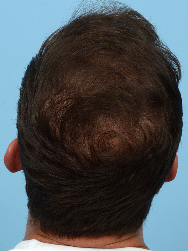 Fue Before and After | Dr. Jeffrey Wise