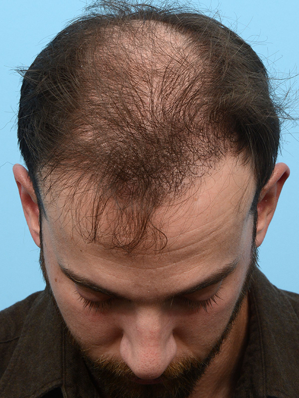 Fue Before and After | Dr. Jeffrey Wise