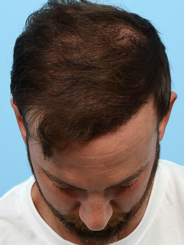 Fue Before and After | Dr. Jeffrey Wise