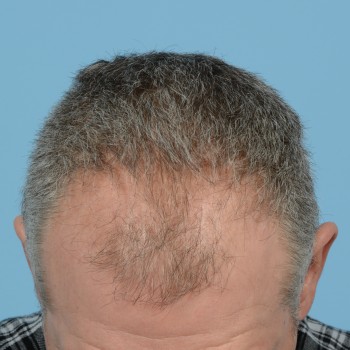 Fue Before and After | Dr. Jeffrey Wise