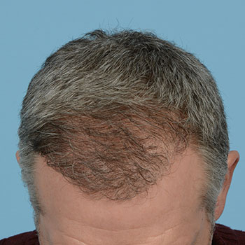 Fue Before and After | Dr. Jeffrey Wise