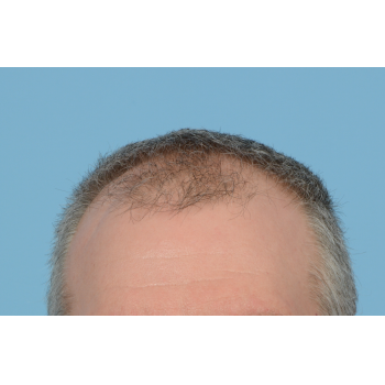 Fue Before and After | Dr. Jeffrey Wise