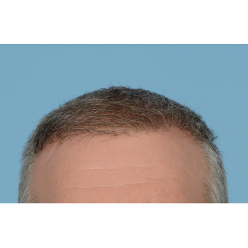 Fue Before and After | Dr. Jeffrey Wise