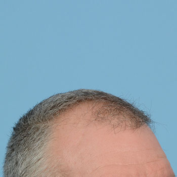 Fue Before and After | Dr. Jeffrey Wise