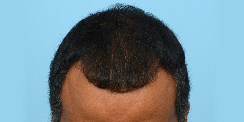 Fue Before and After | Dr. Jeffrey Wise