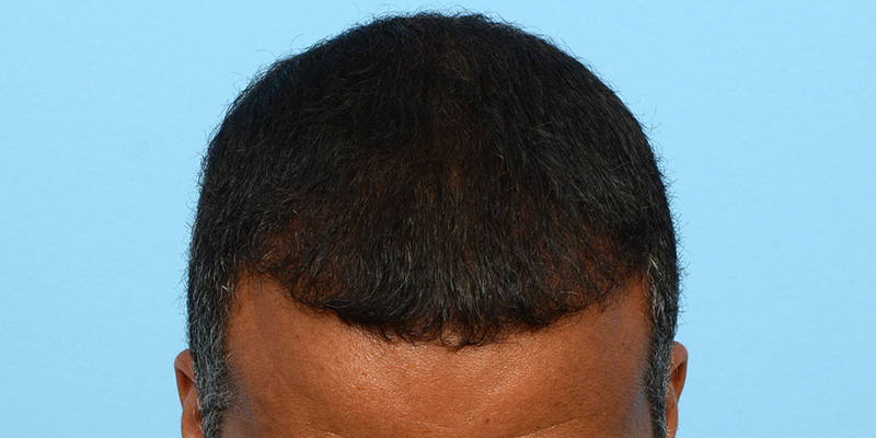 Fue Before and After | Dr. Jeffrey Wise