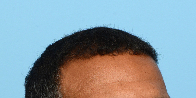 Fue Before and After | Dr. Jeffrey Wise