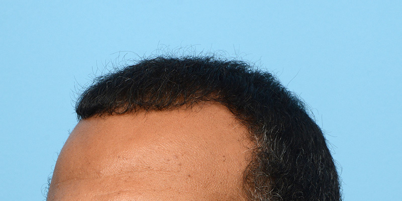 Fue Before and After | Dr. Jeffrey Wise