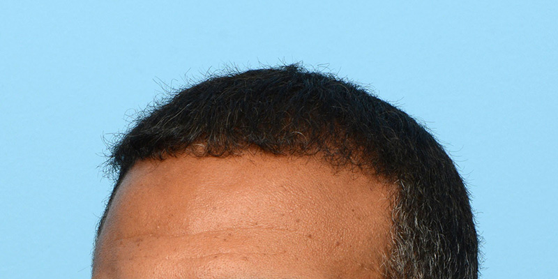 Fue Before and After | Dr. Jeffrey Wise