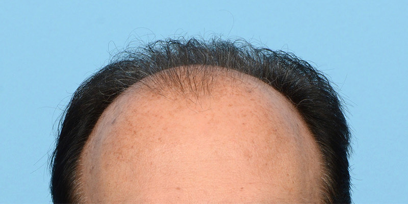 Fue Before and After | Dr. Jeffrey Wise