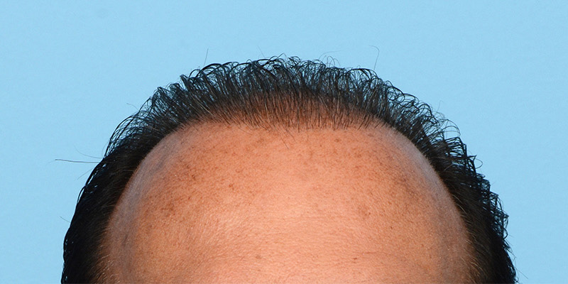 Fue Before and After | Dr. Jeffrey Wise