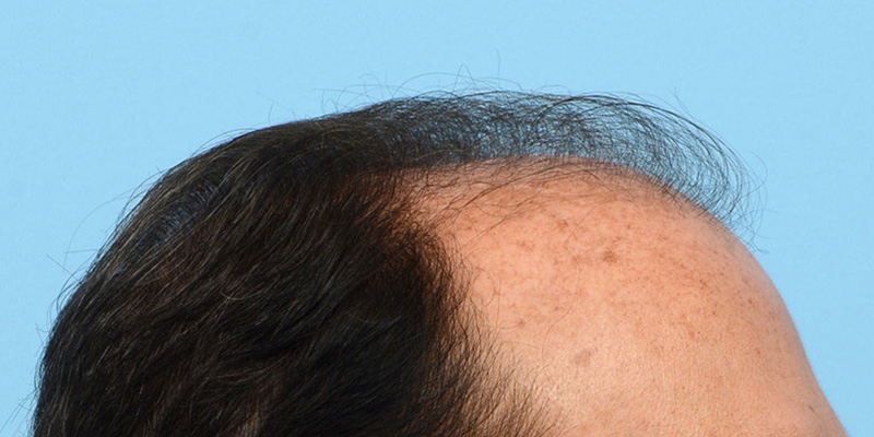 Fue Before and After | Dr. Jeffrey Wise