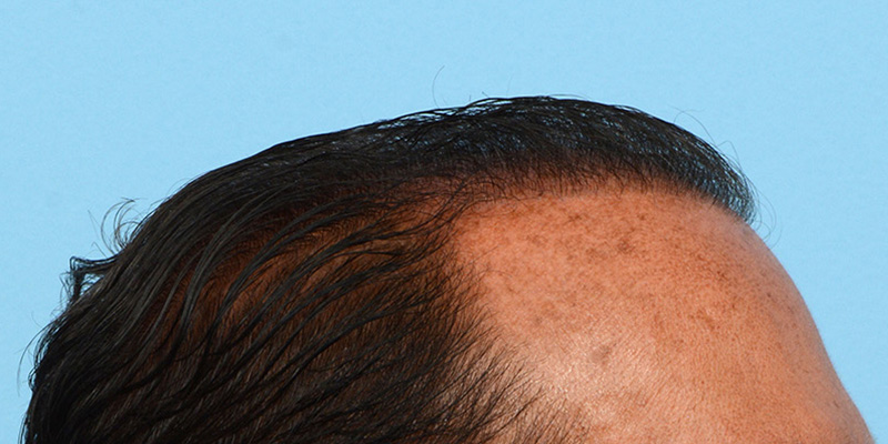 Fue Before and After | Dr. Jeffrey Wise