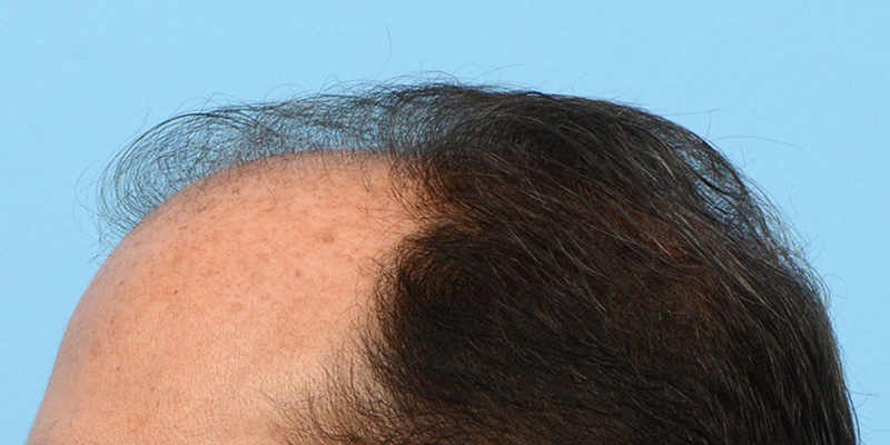 Fue Before and After | Dr. Jeffrey Wise