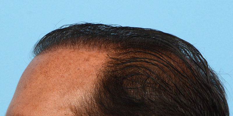 Fue Before and After | Dr. Jeffrey Wise