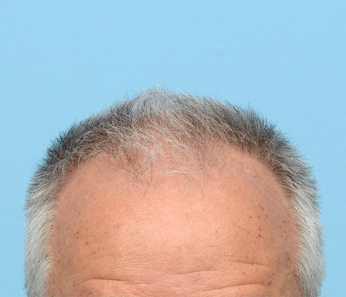 Fue Before and After | Dr. Jeffrey Wise