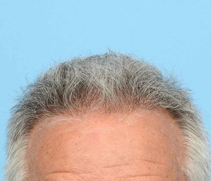 Fue Before and After | Dr. Jeffrey Wise