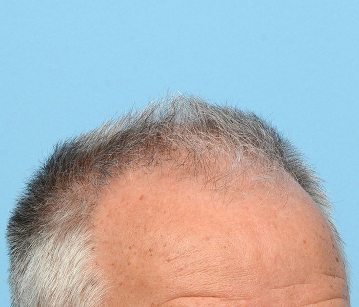 Fue Before and After | Dr. Jeffrey Wise