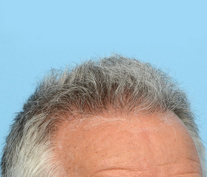 Fue Before and After | Dr. Jeffrey Wise