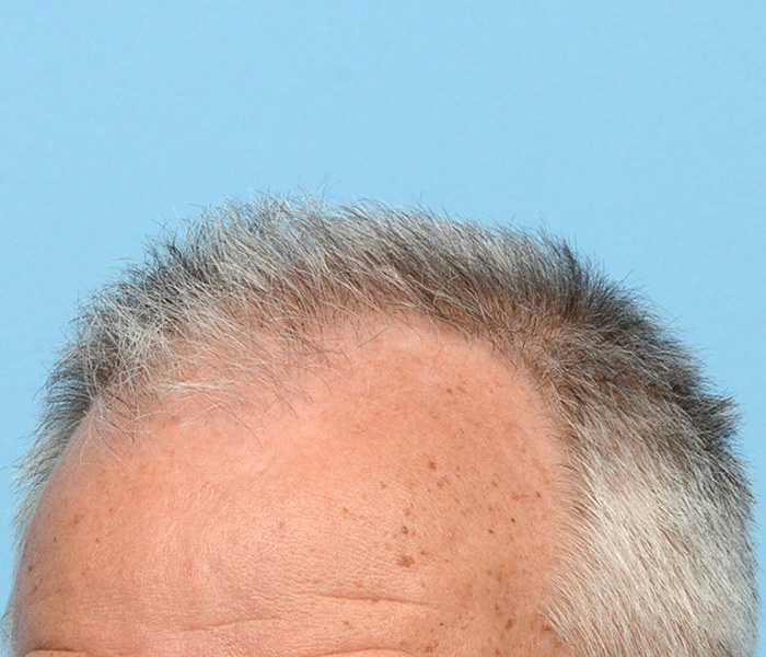 Fue Before and After | Dr. Jeffrey Wise