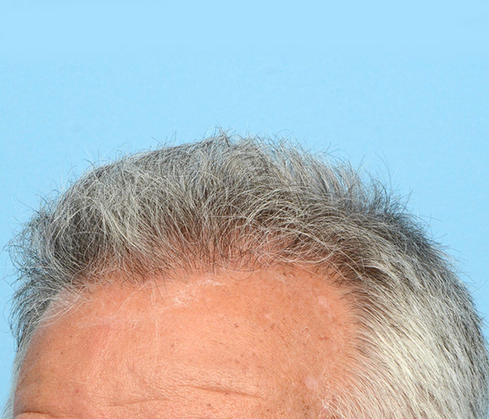 Fue Before and After | Dr. Jeffrey Wise