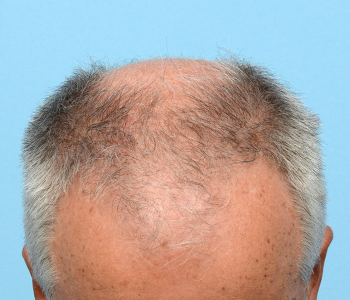 Fue Before and After | Dr. Jeffrey Wise