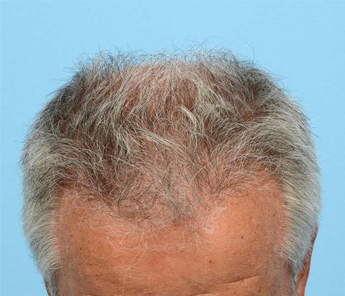 Fue Before and After | Dr. Jeffrey Wise