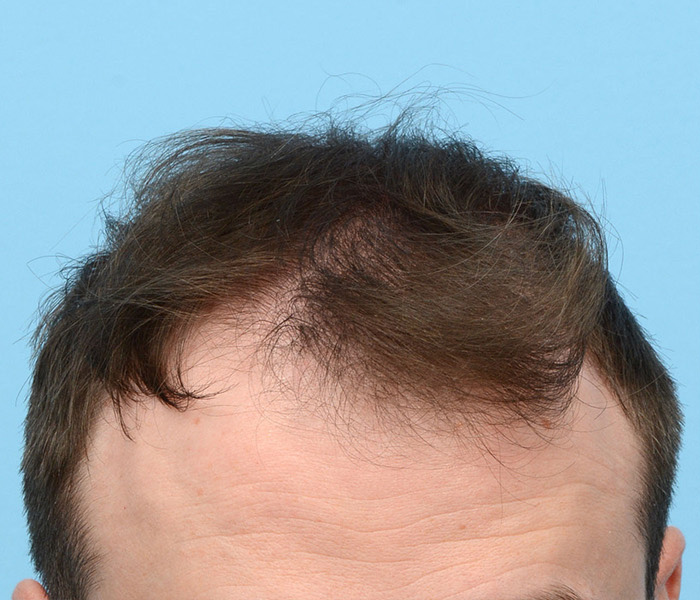 Fue Before and After | Dr. Jeffrey Wise