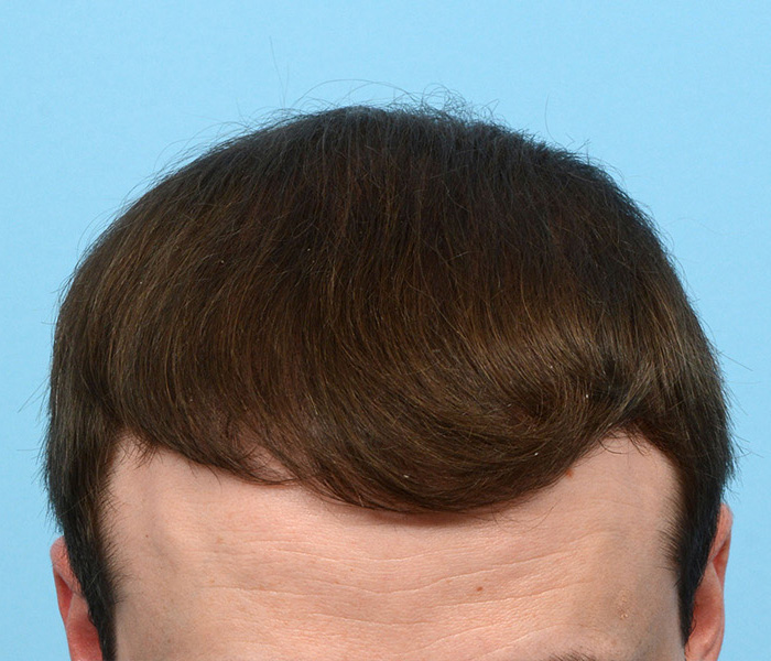 Fue Before and After | Dr. Jeffrey Wise